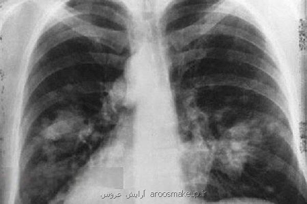 گاز رادن دومین عامل مبتلا شدن به سرطان ریه است