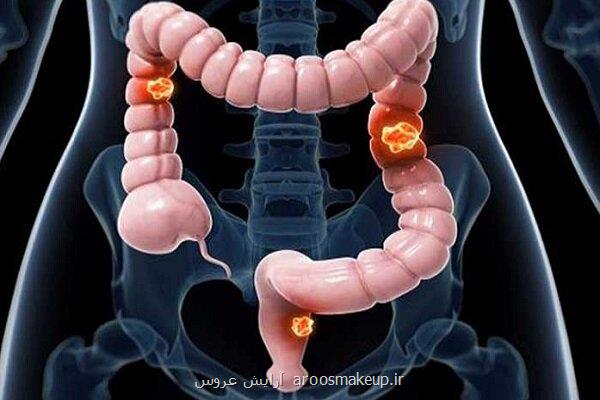 تأثیر ورزش در افزایش طول عمر بازماندگان سرطان روده بزرگ